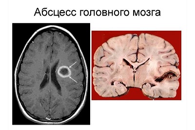 ჩირქგროვა ტვინში (აბსცესი)