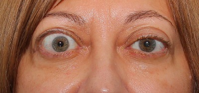 ეგზოფთალმია (ამოზნექილი თვალები) / egzoftalmia (amozneqili tvalebi)