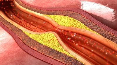 ათეროსკლეროზი / aterosklerozi