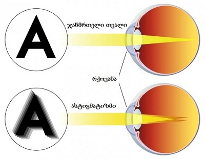 ასტიგმატიზმი / astigmatizmi
